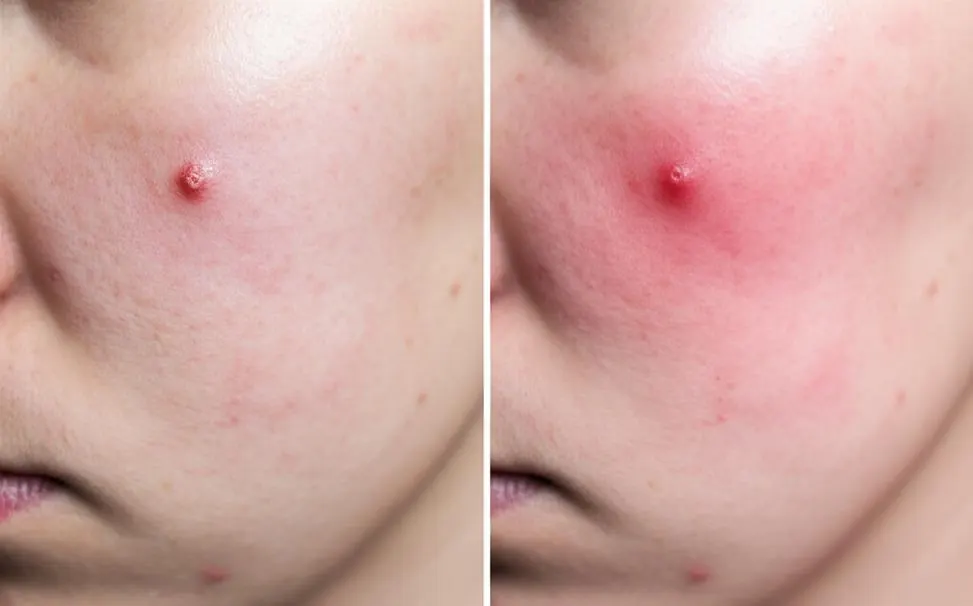 Bí quyết trị mụn bọc siêu tốc: Đánh bay mụn chỉ sau một đêm!